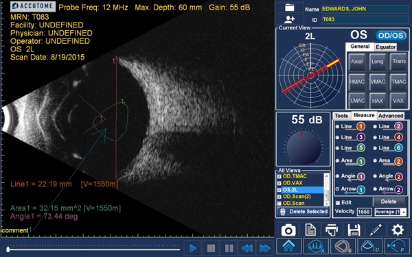 Ultrasonograf keller accutome 4sight badanie